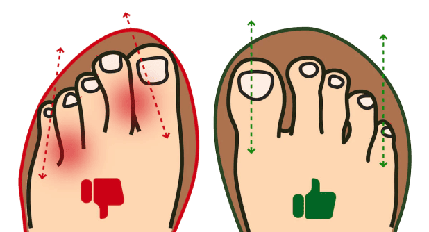 Comparison of cramped toes and natural toe alignment